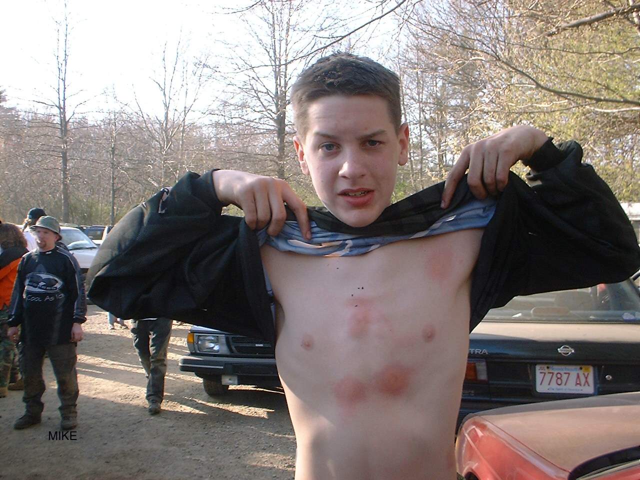welts.jpg